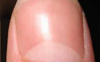 Вросший ноготь. Причины, симптомы, операция удаления ногтя и реабилитация. Полное руководство.