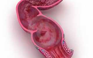 Рак прямой кишки. Симптомы и признаки, стадии, диагностика, лечение и прогноз, профилактика для здоровья