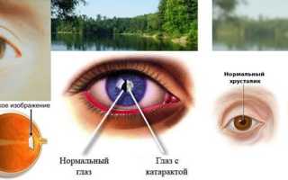 Простые упражнения для глаз при катаракте для улучшения зрения