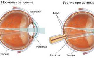 4 основных метода лечения смешанного астигматизма для улучшения зрения