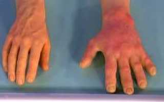 Аллергия на холод. Причины, симптомы, признаки, диагностика и лечение патологии у взрослых