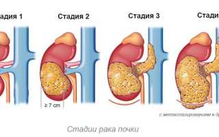 Рак почки 1 стадии