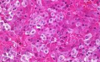 Феохромоцитома. Причины, симптомы, признаки, диагностика и лечение патологии у пациентов.