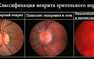 Опасность и прогноз при ретробульбарном неврите зрительного нерва: важные аспекты