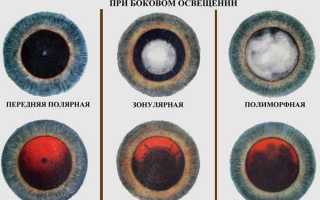 6 типов врожденной катаракты и их особенности: что нужно знать