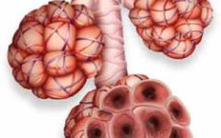Бронхография — суть метода исследования, подготовка, показания, противопоказания и расшифровка результатов для пациентов