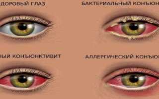 Чем лечить конъюнктивит в зависимости от возбудителя? Полезные советы