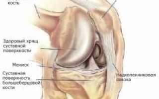 Артроз коленного сустава — причины, симптомы, диагностика и лечение артроза для здоровья