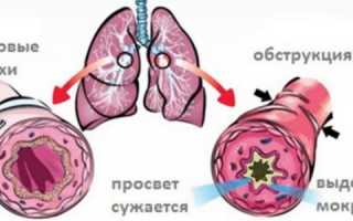 Обструктивный бронхит – причины, лечение и важные особенности болезни для здоровья