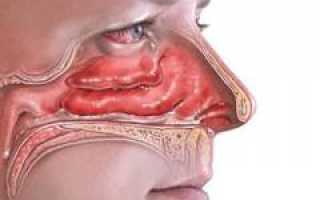 Заложен нос. Причины заложенности носа. Капли от заложенности носа и их применение