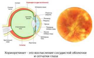 Диагностика и лечение хориоретинита глаза: важные аспекты и рекомендации