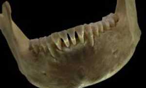 Пародонтоз – причины, симптомы, диагностика и лечение, протезирование зубов для здоровья