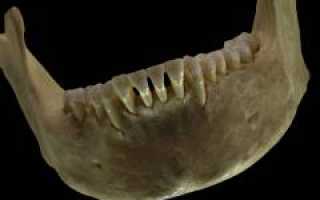 Пародонтоз – причины, симптомы, диагностика и лечение, протезирование зубов для здоровья