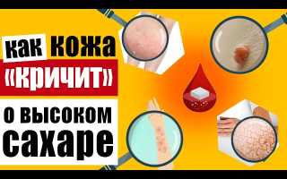 Предупреждающие признаки на коже, которые говорят о высоком уровне сахара в крови, и их значение