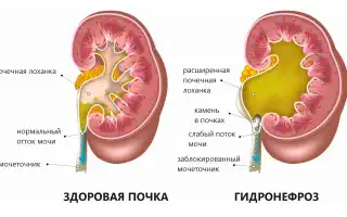 Гидронефроз левой почки что это такое