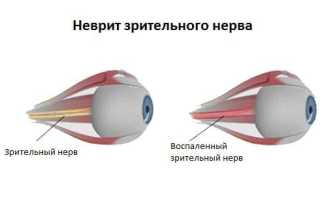 Лечение неврита зрительного нерва: методы и рекомендации