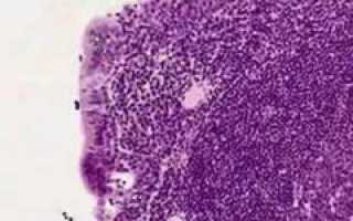 Аденоиды – причины, симптомы, степени, диагностика и лечение. Где находятся аденоиды, почему они воспаляются? Узнайте больше о здоровье.