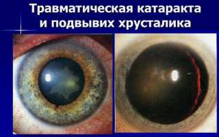 Как действовать при травматической катаракте для улучшения зрения