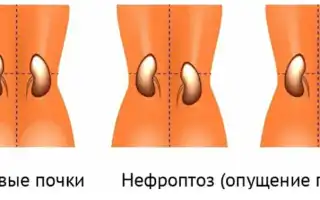 Нефроптоз 1 степени что это такое