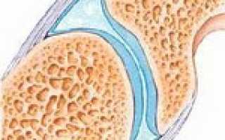 Артроз суставов — симптомы, стадии, современная диагностика и методы эффективного лечения для здоровья