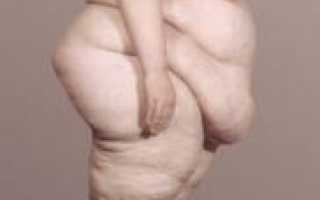 Ожирение — основные причины, принципы лечения ожирения. Связь ожирения и эмоциональных расстройств в современном обществе.