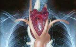 Зоб щитовидной железы: причины, симптомы, диагностика и лечение заболевания