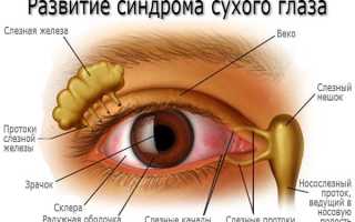 4 стадии развития синдрома сухого глаза: причины и симптомы