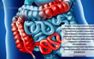 Илеит. Причины, симптомы, диагностика и лечение патологии у пациентов