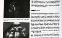 Гиперэхогенные включения в почках что это такое