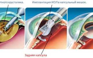 Особенности и преимущества факоэмульсификации катаракты для пациентов