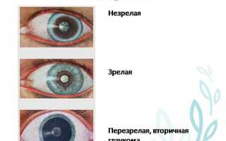5 лучших средств от незрелой катаракты для эффективного лечения
