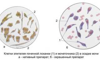 Клетки плоского эпителия в моче