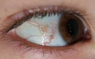 Желтые глаза. Причины желтизны белков глаз, диагностика причин, лечение патологий и профилактика