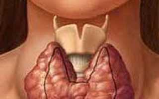 Диффузный токсический зоб (ДТЗ), гипертиреоз — симптомы, диагностика, лечение и профилактика патологии заболевания щитовидной железы