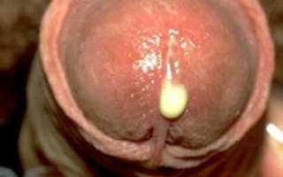 Гонорея — симптомы у мужчин и женщин, анализы, провокация гонореи, эффективное лечение и профилактика