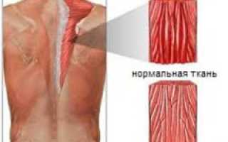 Миозит — причины, симптомы и признаки, диагностика и лечение патологии у взрослых