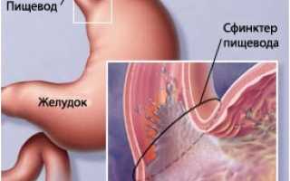 Изжога — причины, болезни при которых появляется изжога, современное лечение, изжога при беременности и советы по профилактике
