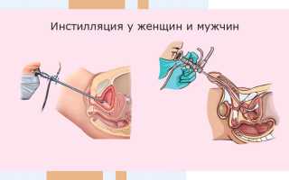 Инсталляция мочевого пузыря