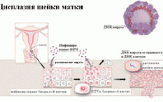 Дисплазия шейки матки — степень дисплазии, диагностика (кольпоскопия, выскабливание, биопсия шейки матки), причины, эффективное лечение и профилактика