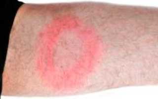 Боррелиоз (болезнь Лайма, болезнь Лима, Лайм-боррелиоз). Причины, симптомы, признаки, диагностика, лечение и профилактика патологии у человека