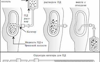 Виды диализа