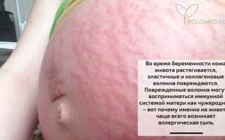 Зудящая красная сыпь на животе во время беременности: причины, диагностика и лечение для будущих мам