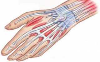 Гигрома. Причины, симптомы, виды, лечение и реабилитация: полное руководство