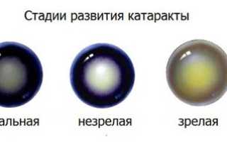 Методы лечения возрастной катаракты для улучшения зрения
