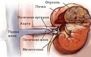 Ангиомиолипома левой почки что это такое