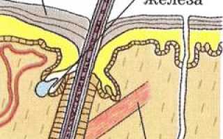 Гидраденит. Причины, симптомы, диагностика и лечение болезни у взрослых.