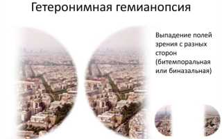 Клинические проявления и виды гемианопсии: диагностика и лечение
