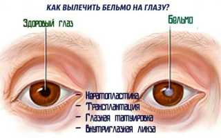 Чем опасно бельмо и как его лечить правильно
