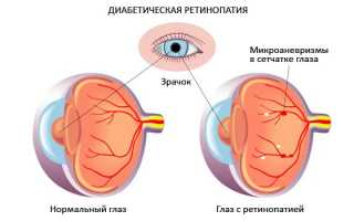 3 стадии диабетической ретинопатии: симптомы и лечение
