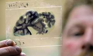 Болезнь Альцгеймера — причины, симптомы, диагностика и лечение у пациентов